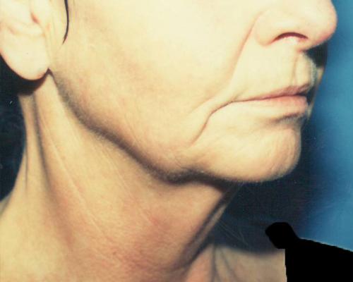 Face & Neck Lift