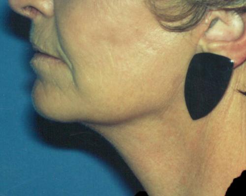 Face & Neck Lift