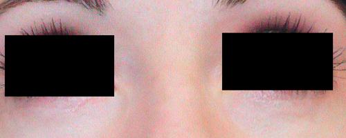 Eyelid Surgery