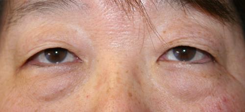 Eyelid Surgery
