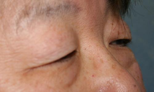 Eyelid Surgery
