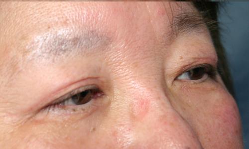 Eyelid Surgery