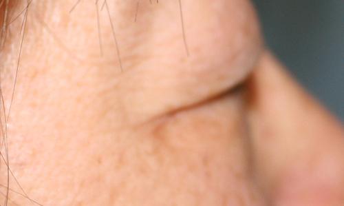 Eyelid Surgery