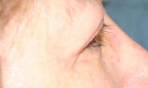 Eyelid Surgery