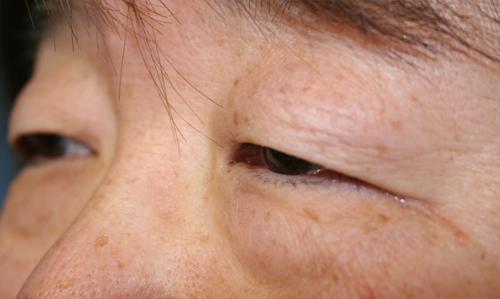 Eyelid Surgery