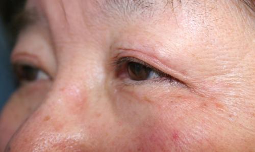Eyelid Surgery