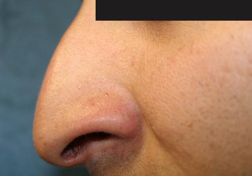 Rhinoplasty