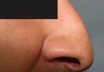 Rhinoplasty