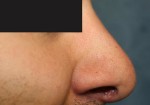 Rhinoplasty