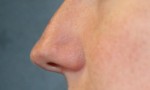 Rhinoplasty