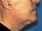 Face & Neck Lift