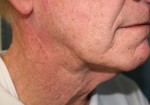 Face & Neck Lift