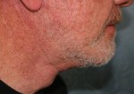 Face & Neck Lift