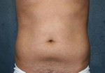 Liposuction