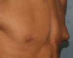 Male Breast Reduction Torrance