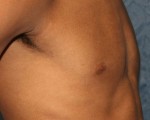 Male Breast Reduction Results Torrance