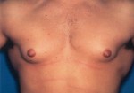 Male Breast Reduction