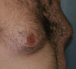 Male Breast Reduction