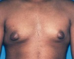 Male Breast Reduction