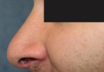 Rhinoplasty