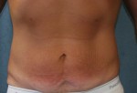 Tummy Tuck