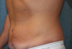 Tummy Tuck