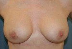 Breast Implant Revision and Capsule Removal