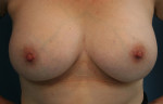 Breast Augmentation