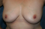 Breast Augmentation