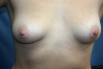 Breast Augmentation