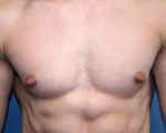 Male Breast Reduction