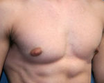 Male Breast Reduction