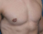 Male Breast Reduction