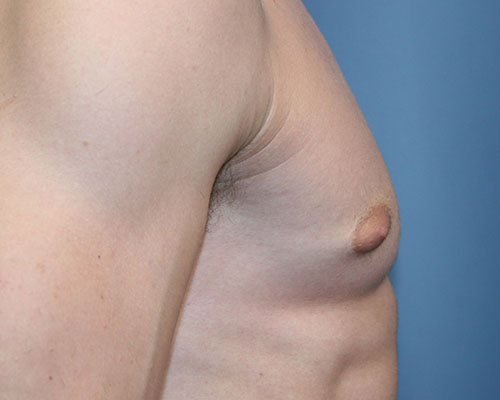 Male Breast Reduction