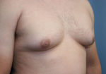 Male Breast Reduction