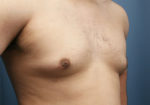 Male Breast Reduction